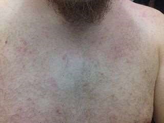 Prickly heat rash on chest